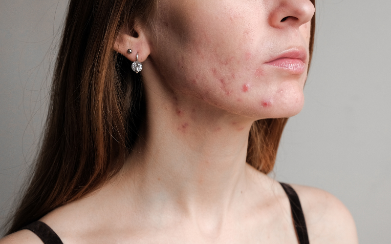 Eliminate Cystic Acne Naturally: Genetic Study Uncovers the Root Cause of 'Super Acne' in Young Women